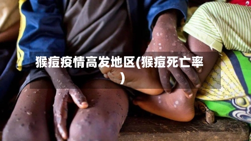 猴痘疫情高发地区(猴痘死亡率)-第2张图片